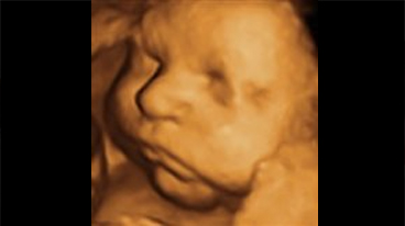 3D ultrasound showing a baby's nose, lips and chin