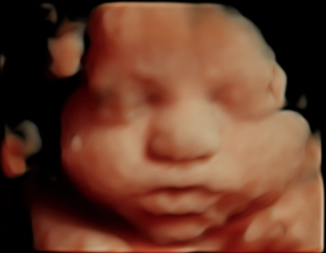 HD Live 3D ultrasound portrait captured at Toes to Nose