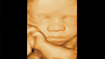 4D ultrasound of a sleeping baby in the womb