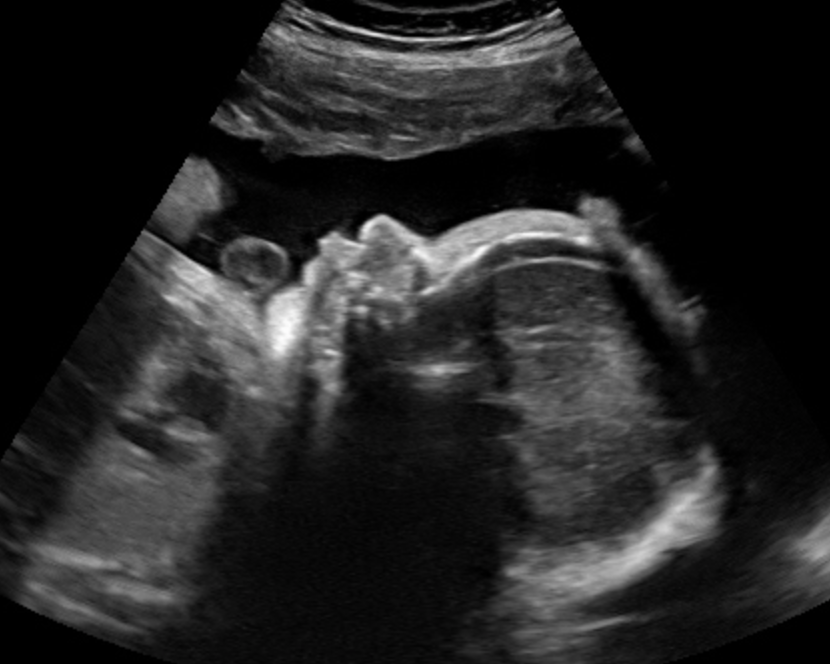 Detailed 4D ultrasound image of a baby's face